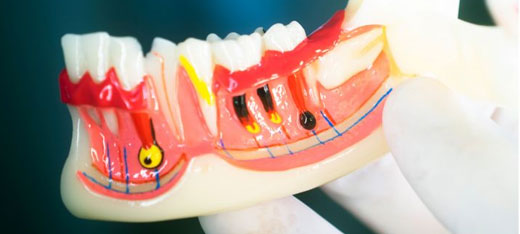 What is tooth decay?