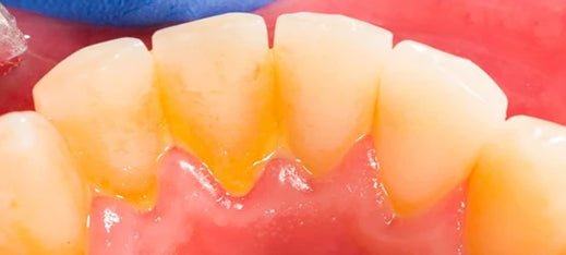 Connaître la Plaque Dentaire